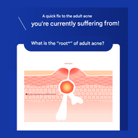 Pair Acne Cream W [2nd-Class OTC Drug]
